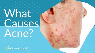 What Causes Acne  Explained by Dermatologist [upl. by Edy207]