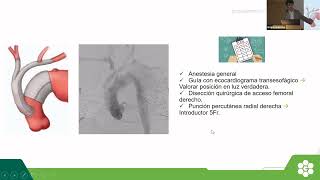 Aorta Endovascular Rosario 2022  Disección aórtica tipo B crónica ¿Cuándo y cómo intervenir [upl. by Schlessinger]