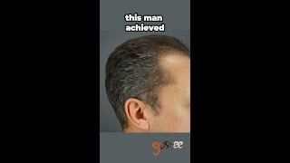 Hair Loss 10 Month Transformation [upl. by Woodie]