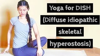 Yoga for DISH Diffuse idiopathic skeletal hyperostosis l In Hindi l Archies Yoga [upl. by Wendell349]