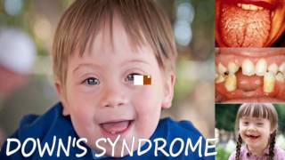 Downs syndrome Etiology Clinical Features and Oral Manifestations  Oral Pathology [upl. by Hardner]