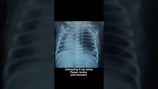 Newborn Xray l Interesting Xray seriespause review and comment nicu [upl. by Betti]