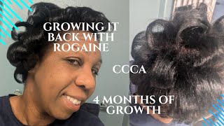 BEATING ALOPECIA AMAZING GROWTH [upl. by Hobey]