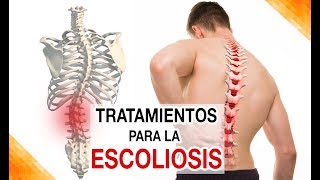 ¿Cuáles son los tratamientos para Escoliosis lumbar dorsal [upl. by Mcallister551]