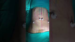 Tummy Tuck Abdominoplasty Procedure  Handa Aesthetics shortsfeed shorts [upl. by Nere]