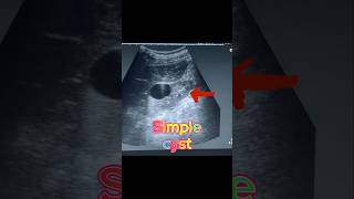 Simple Renal Cyst  Cortical Cyst  Kidney Cyst on Ultrasound [upl. by Werner]