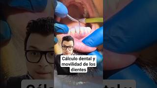 Encías INFLAMADAS Cálculo y Movilidad de los Dientes gingivitis odontologia [upl. by Sabba]