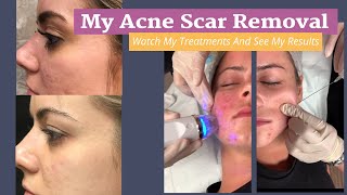 My Acne Scar Removal Journey RF Microneedling with PRP Treatments and Results [upl. by Nichole]