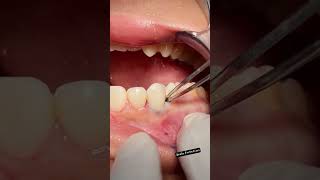 Scaling and Root Planing for Gum Disease MouthHealthy tartar teethscalling dental dentist toot [upl. by Seiden]