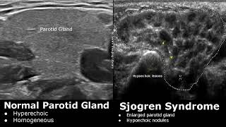 Salivary Glands Ultrasound Normal Vs Abnormal Images  Parotid Submandibular amp Sublingual Gland USG [upl. by Chaiken]