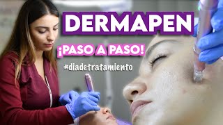 DERMAPEN  TRATAMIENTO DE MICRONEEDLING  Ximena Ramaya [upl. by Kuska]