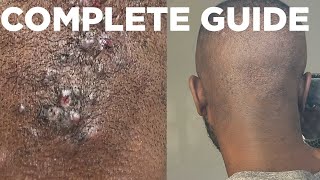 HOW TO TREAT BUMPS ON BACK OF THE NECK  ACNE KELOIDALIS NUCHAE  FULL GUIDE 2023 [upl. by Jun194]