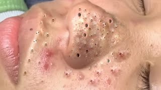 Big Cystic Acne Blackheads Extraction Blackheads amp Milia Whiteheads Removal Pimple Popping  3628 [upl. by English]