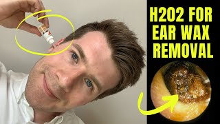 How to remove EAR WAX at home using HYDROGEN PEROXIDE H202 solution  Doctor ODonovan explains [upl. by Dru]