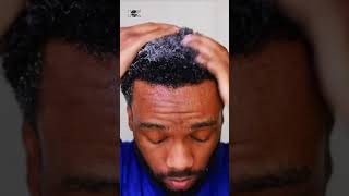 Hair Transplant Week 32👨🏾‍🦲‼️ [upl. by Iris314]