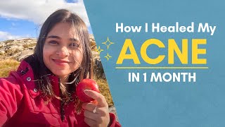 How I Healed My Acne in 1 Month [upl. by Aicsila]