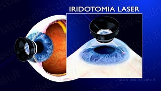 Glaucoma ad angolo chiuso e glaucoma acuto terapia con iridotomia laser wwwoculisticaTVit [upl. by Elletnohs]