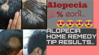 ALOPECIA AREATA HOME TREATMENT RESULTS MALYALAMll വട്ടത്തിൽ മുടി കൊഴിച്ചിൽ ll MIND ME ENTERTAINMENTl [upl. by Hillery]