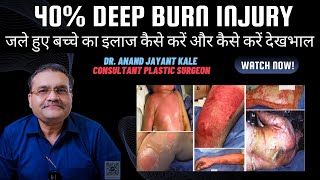 40 Deep Burn Injury  40 जले हुए बच्चे का इलाज कैसे करें और कैसे करें देखभाल [upl. by Freeland316]