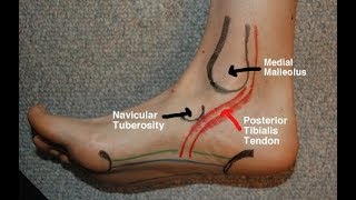 Posterior Tibial Tendinitis Evaluation with Paul Marquis PT [upl. by Nagol]