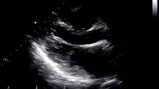 Constrictive Pericarditis Following Heart Transplant 1 [upl. by Roach]