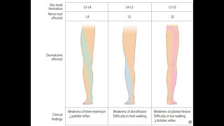 Lumbosacral radiculopathy [upl. by Adnahsam]