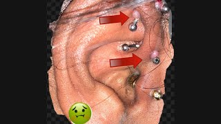 Fast and easy way to get rid of piercing bumps Photos included 🤢🤮🤮🤢 [upl. by Champagne]