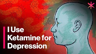 I Use Ketamine for Depression  Here’s How It Works [upl. by Annahael209]