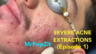 Severe acne extractions episode 1 Comedones and pore dirt removed Part 1 of 3 So many pops [upl. by Aurelia985]