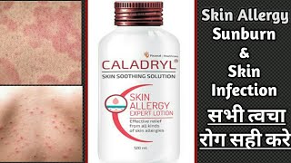 Caladryl Skin Soothing Lotion Review  Skin allergy infection itching amp Sunburn medicine [upl. by Danziger426]