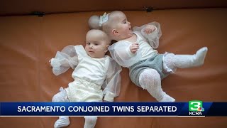 Celebrating a miracle Conjoined twin girls successfully separated at UC Davis Medical Center [upl. by Ennagrom611]