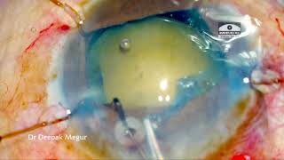 Capsule Tension Ring CTR part 3 final CTR in SICS case Dr Deepak Megur [upl. by Annehs385]