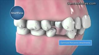 Invisalign G6 Clinical Innovations for First Premolars Extraction [upl. by Tuinenga]