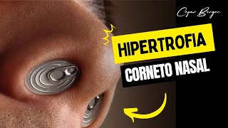 HIPERTROFIA DO CORNETO NASAL [upl. by Lateehs830]