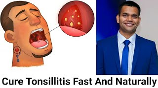 How To Cure Tonsillitis Fast And Naturally Powerful Home Remedies For Tonsil Stones That Works Fast [upl. by Violette787]