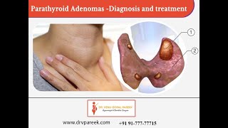 Adenomas Symptoms and Causes  Diagnosis  Treatment  Prevention [upl. by Josepha22]