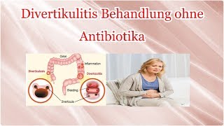 Divertikulitis Behandlung ohne Antibiotika [upl. by Adnahsam]