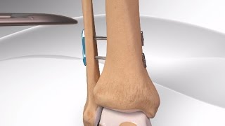 High Ankle Sprain [upl. by Herries]