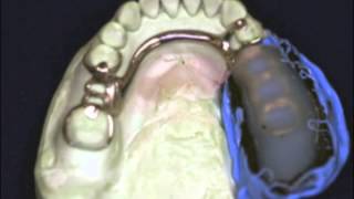 Parts of a cast partial denture  Prosthodontics [upl. by Plante943]