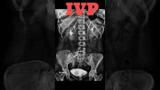 IVP  Intravenous pyelography shorts ivp specialcase radiology radiologyjunction [upl. by Mccormac]