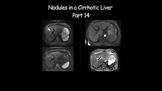 Nodules in a Cirrhotic Liver  Part 14 radiology radiologist cirrhosis liverdisease liverhealth [upl. by Autumn]