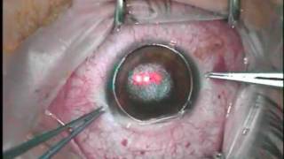 Intralase LASIK in a case with nystagmus [upl. by Dolley]