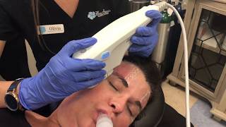 Endoscopic Brow Lift Video  Before amp After Brow Lift [upl. by Wolfgang]