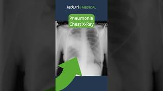 Understanding Lobar Pneumonia 🫁 MedicalEducation usmle [upl. by Lennaj]