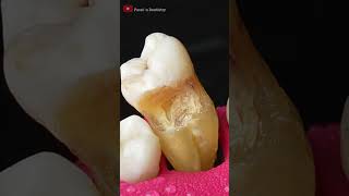 Hidden Tooth Cavity asmr dentist [upl. by Nivlag706]