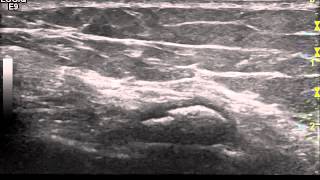 Ultrasound Large loose body Lat PFJ  Dr Peter Resteghini [upl. by Dent]