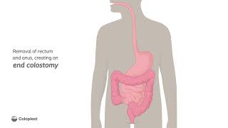 Creation of end colostomy by removing rectum and anus  Ostomy surgery  Coloplast India [upl. by Aivila421]