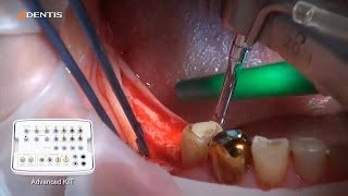 DENTIS Implant Implantation and Soft Tissue Augmentation at 46 47 [upl. by Sirrep]