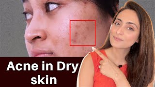 Acne in Dry Skin  what to use  serums creams  Dermatologist recommends [upl. by Asilej]