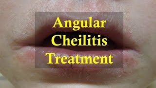 How to cure Angular Cheilitis Naturally [upl. by Chadd]